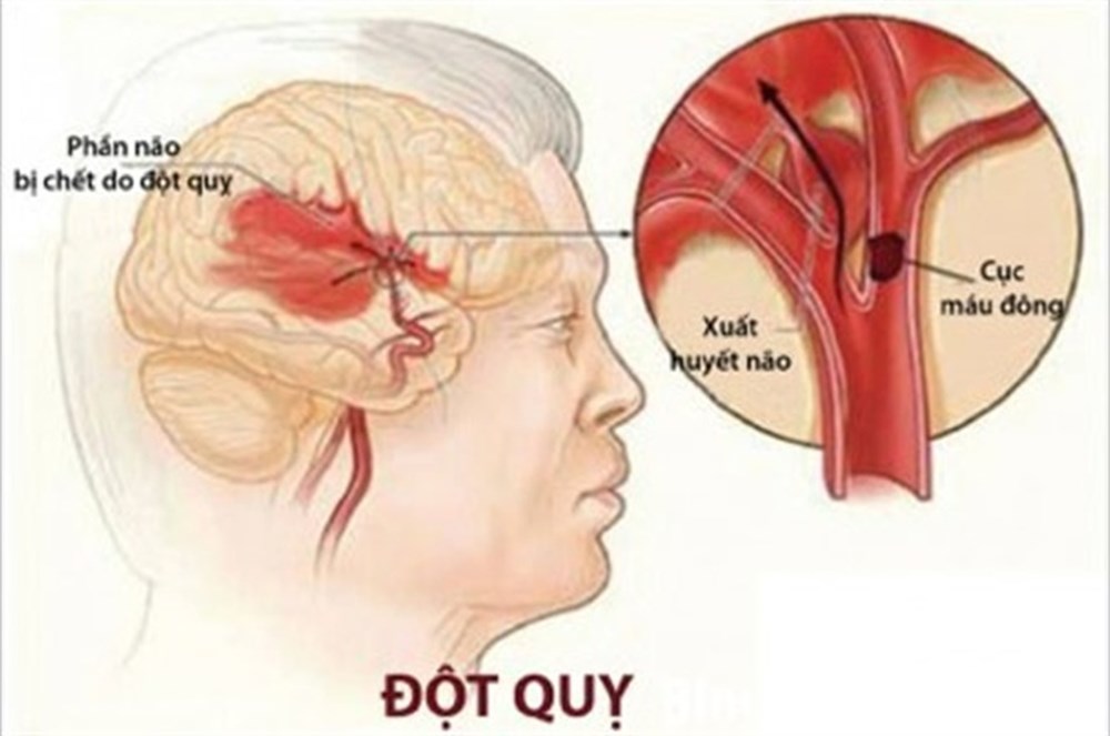 mơ đột quỵ